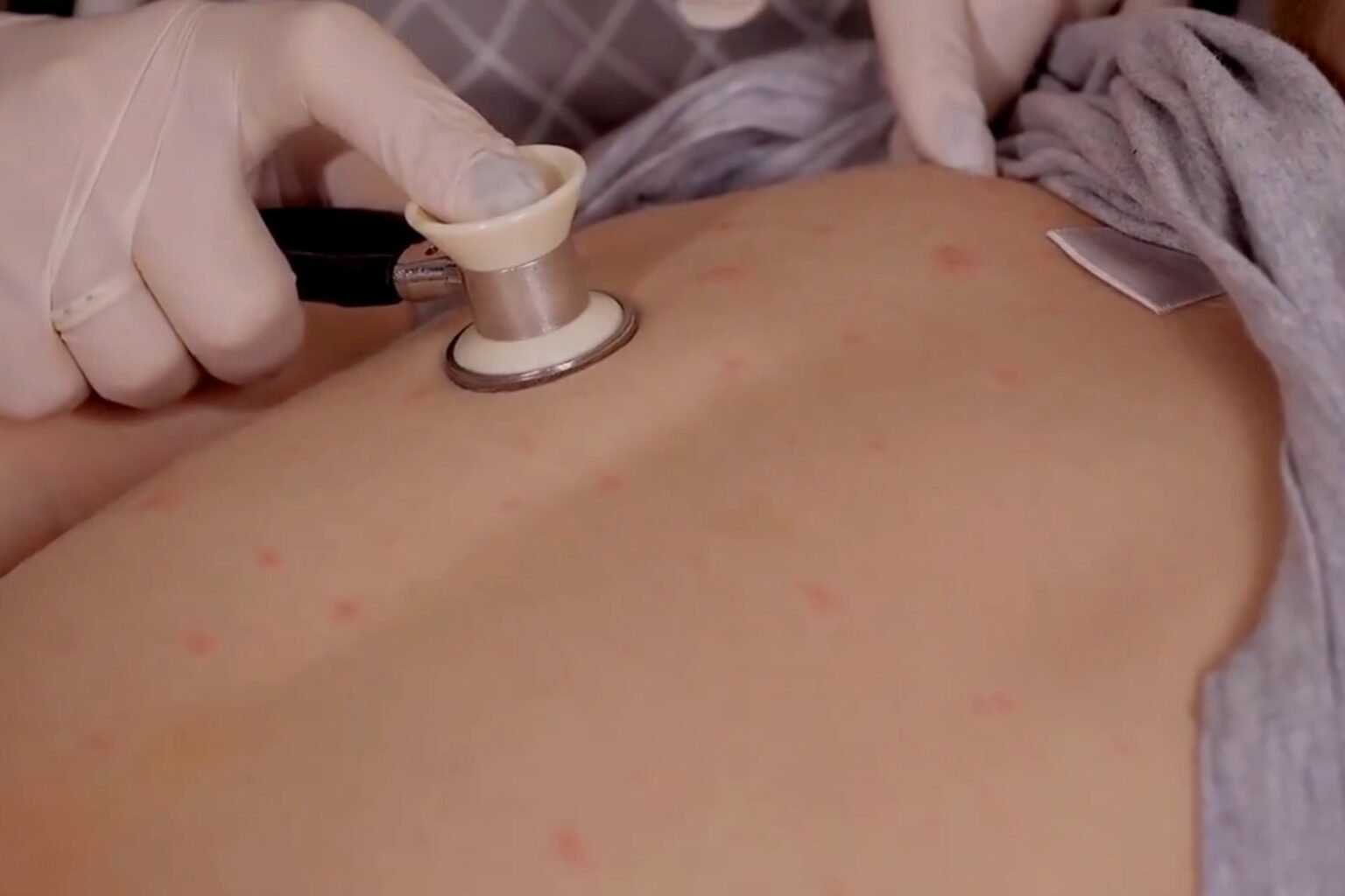 Suben a 31 las muertes por sarampión, ¿dónde ocurrieron los últimos decesos?