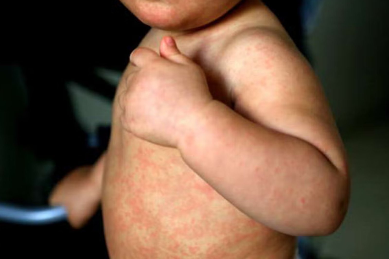 Vacunación masiva y ‘barridos’ en colonias: Así va la estrategia táctica de México para asfixiar el brote de sarampión